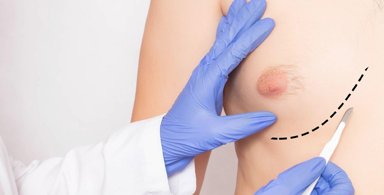 Nipple Areolea Reduction or Augmentation