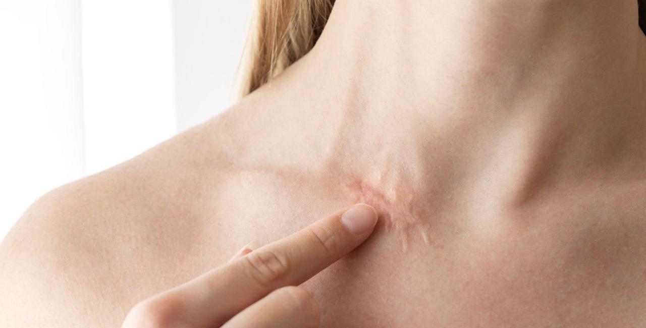 Scar Revision